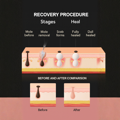 Quistons Beauty Pen — See Visible Results Fast Effectively Removes Moles, Skin Tags, Cherry Angiomas & Warts